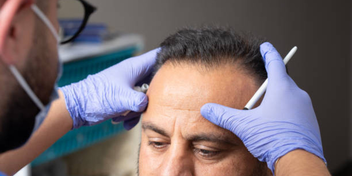 زراعة شعر اللحى والحواجب: توسيع نطاق الجمال في دبي